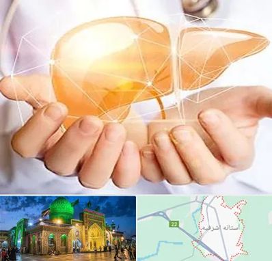 دکتر سرطان کبد در آستانه اشرفیه