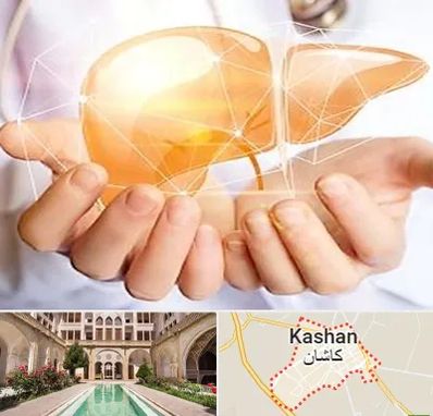 دکتر سرطان کبد در کاشان