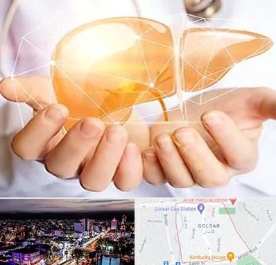 دکتر سرطان کبد در گلسار رشت 