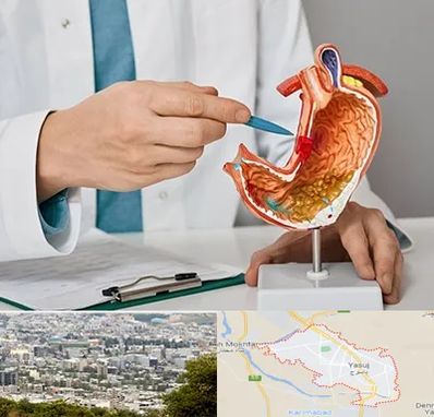 دکتر سرطان معده در یاسوج