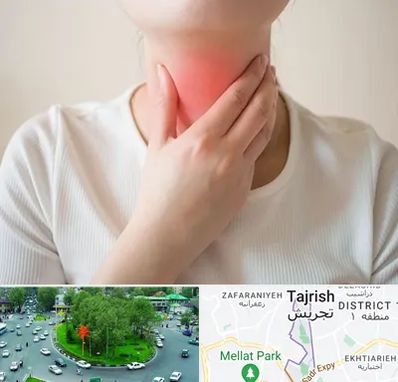 دکتر سرطان مری در تجریش 