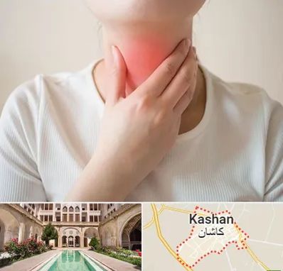 دکتر سرطان مری در کاشان