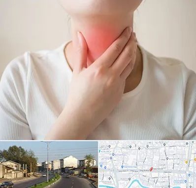 دکتر سرطان مری در ضیابری رشت 