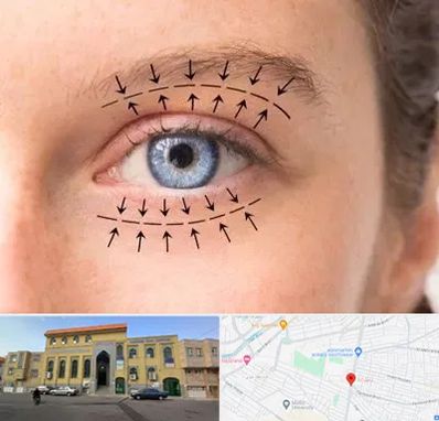 عمل افتادگی پلک در زنبیل آباد قم