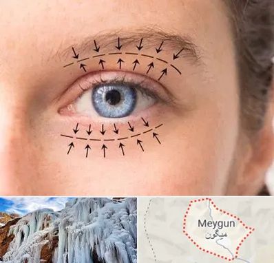 عمل افتادگی پلک در میگون