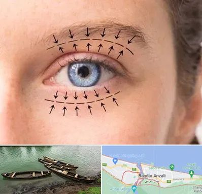 عمل افتادگی پلک در بندر انزلی