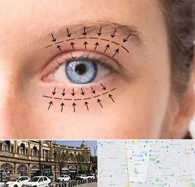 عمل افتادگی پلک در منطقه 11 تهران