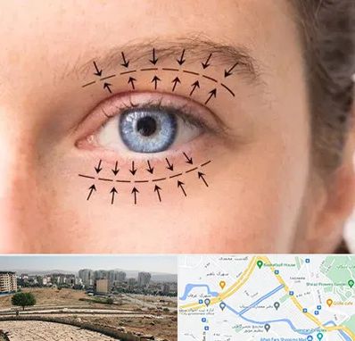 عمل افتادگی پلک در کوی وحدت شیراز