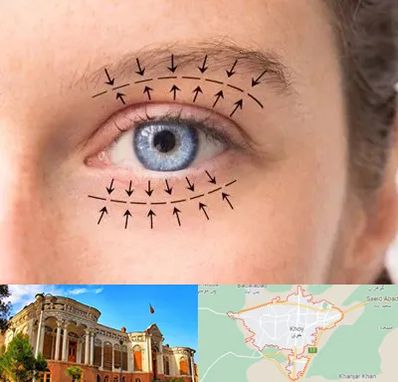 عمل افتادگی پلک در خوی