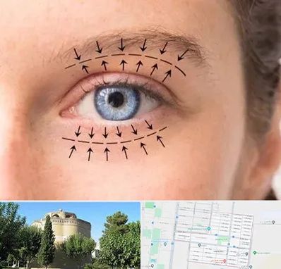 عمل افتادگی پلک در مرداویج اصفهان