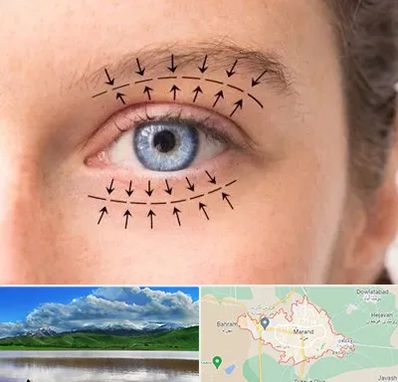 عمل افتادگی پلک در مرند