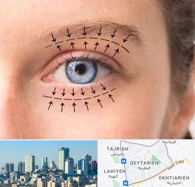 عمل افتادگی پلک در قیطریه