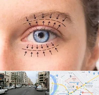 عمل افتادگی پلک در زیتون کارمندی اهواز