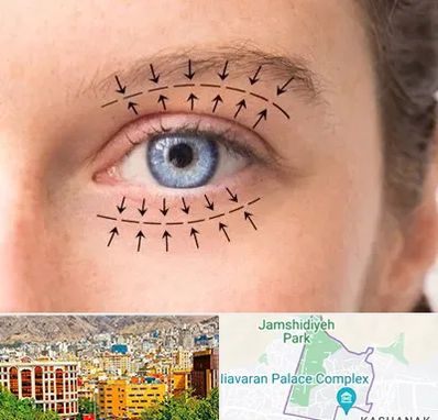 عمل افتادگی پلک در نیاوران