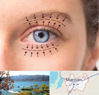 عمل افتادگی پلک در مریوان