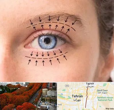 عمل افتادگی پلک در ولیعصر