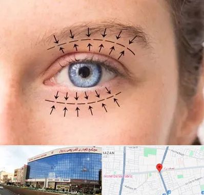 عمل افتادگی پلک در نصف راه تبریز