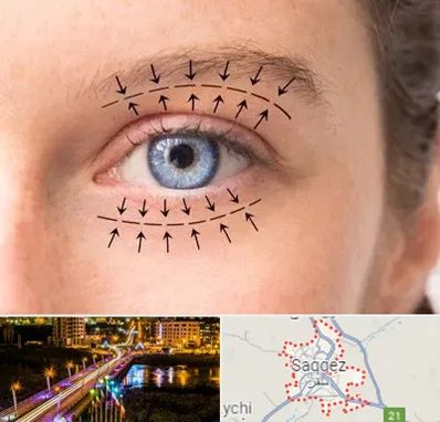 عمل افتادگی پلک در سقز