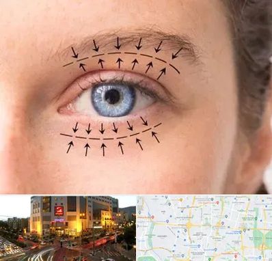 عمل افتادگی پلک در جنت آباد تهران