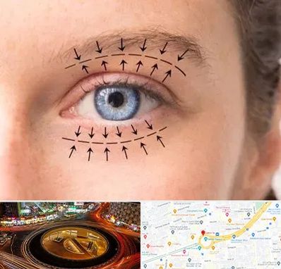 عمل افتادگی پلک در میدان ولیعصر