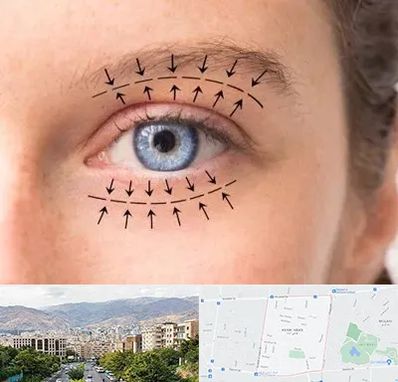 عمل افتادگی پلک در خانی آباد