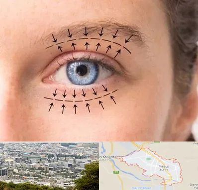 عمل افتادگی پلک در یاسوج