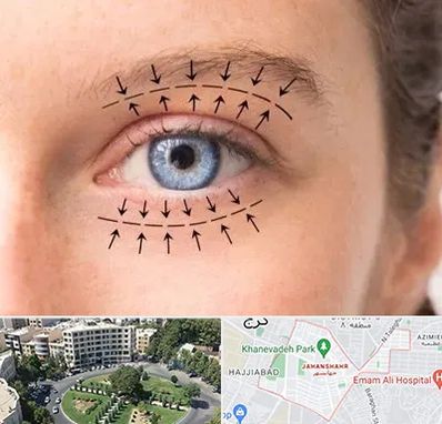 عمل افتادگی پلک در جهانشهر کرج