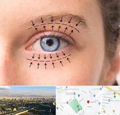 عمل افتادگی پلک در هنگام