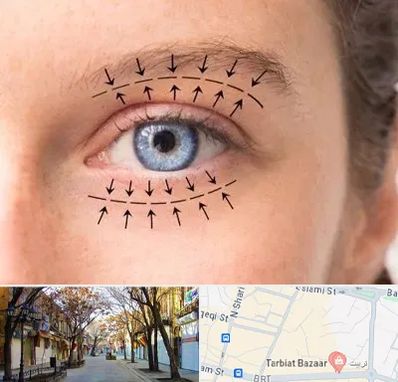 عمل افتادگی پلک در تربیت تبریز