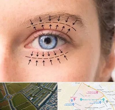 عمل افتادگی پلک در الهیه مشهد