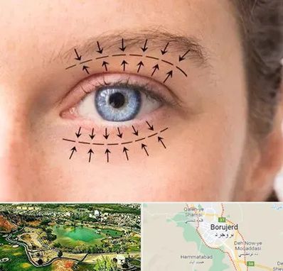 عمل افتادگی پلک در بروجرد