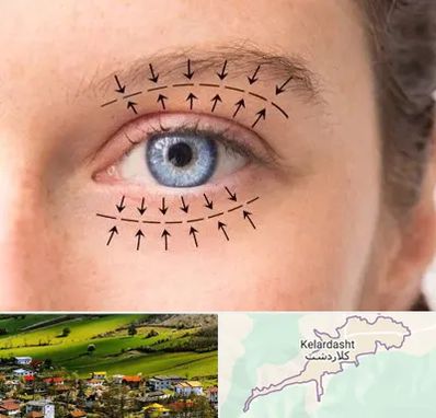 عمل افتادگی پلک در کلاردشت