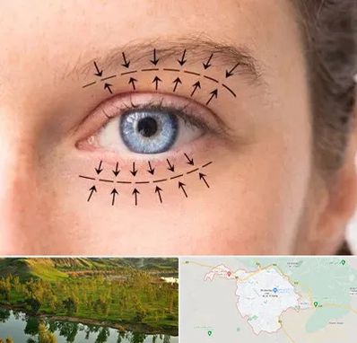 عمل افتادگی پلک در بهبهان