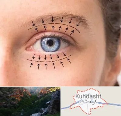 عمل افتادگی پلک در کوهدشت