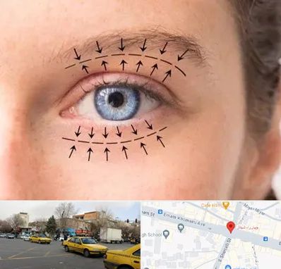 عمل افتادگی پلک در شهناز تبریز