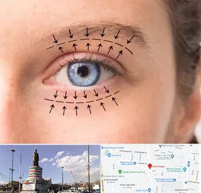 عمل افتادگی پلک در کارگر جنوبی