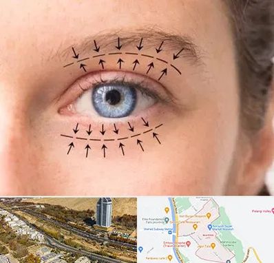 عمل افتادگی پلک در خیابان نیایش شیراز