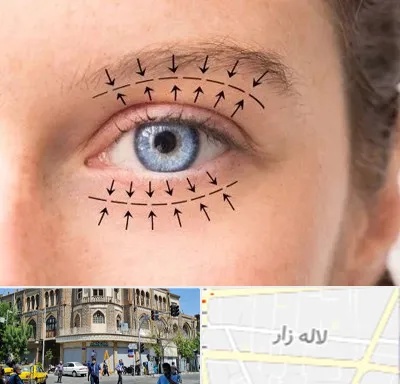 عمل افتادگی پلک در لاله زار