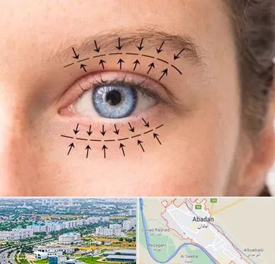 عمل افتادگی پلک در آبادان