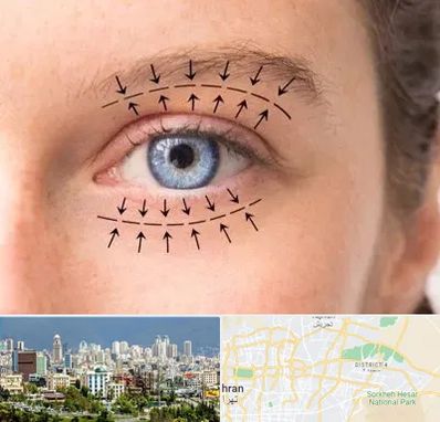 عمل افتادگی پلک در شرق تهران تهران