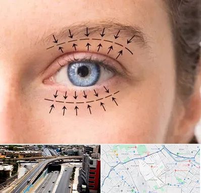 عمل افتادگی پلک در ستارخان شیراز