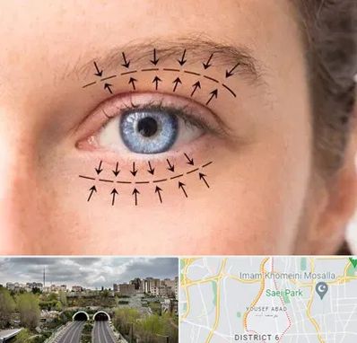 عمل افتادگی پلک در یوسف آباد