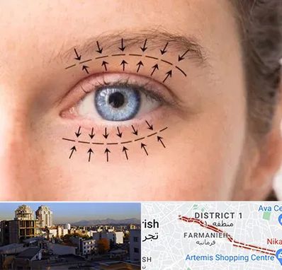 عمل افتادگی پلک در فرمانیه