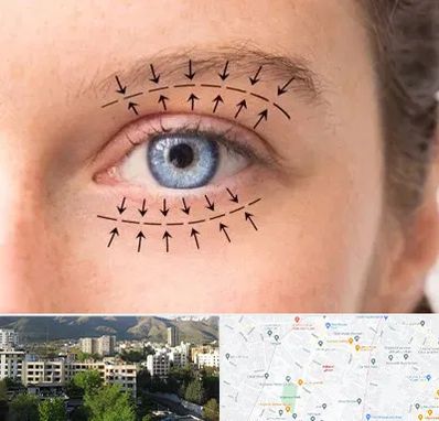 عمل افتادگی پلک در دیباجی