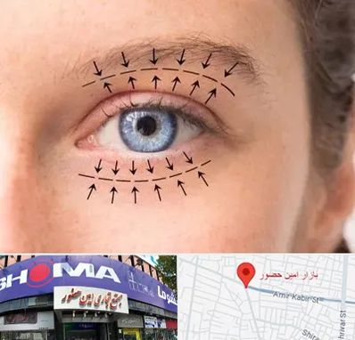 عمل افتادگی پلک در امین حضور