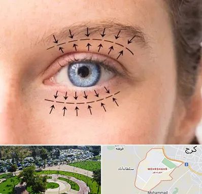عمل افتادگی پلک در مهرشهر کرج