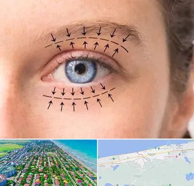 عمل افتادگی پلک در فریدونکنار