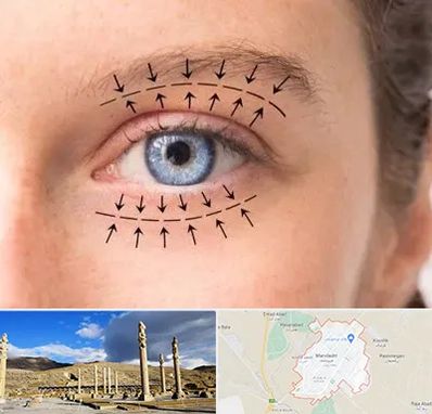 عمل افتادگی پلک در مرودشت
