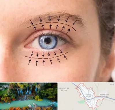 عمل افتادگی پلک در دورود