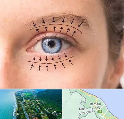عمل افتادگی پلک در رامسر